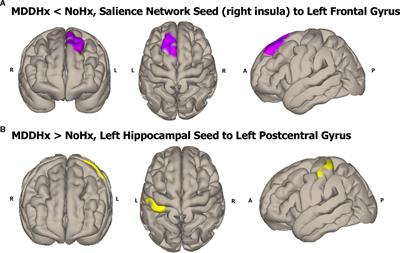 Persistent Intrinsic Functional Network Connectivity Alterations in Middle-Aged and Older Women With Remitted Depression